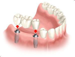 Dental Implant | Dentist in Port Orange, FL | Ultimate Dental Studio